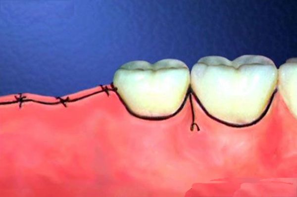 Trồng răng implant sau bao lâu cắt chỉ được?