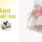 Lấy dấu răng implant là gì? Giải pháp lấy dấu răng nhanh chóng