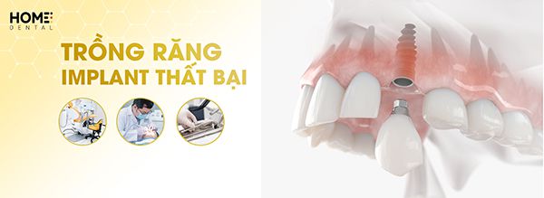 Biểu hiện việc trồng răng implant thất bại chắc chắn cần biết