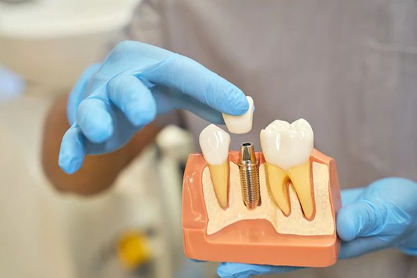 Trường hợp nên thực hiện cấy ghép implant không rạch lợi 