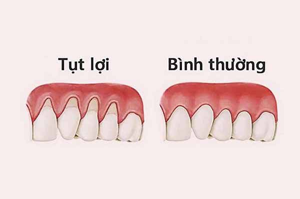 Tụt lợi là gì