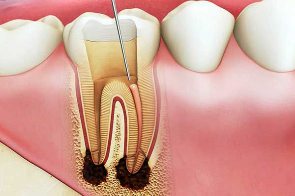 Bọc răng sứ có nên lấy tủy