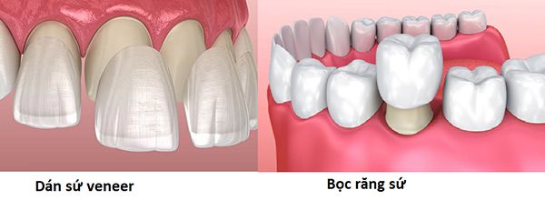 Nên bọc răng sứ hay dán veneer