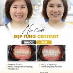 Kỹ thuật bọc răng sứ đúng chuẩn chắc chắn phải biết?