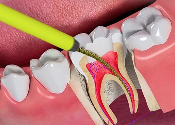 Khi nào cần diệt tuỷ răng sâu có đau không?