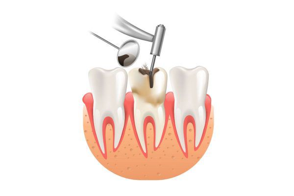 Lợi ích bọc răng sứ có nên lấy tủy