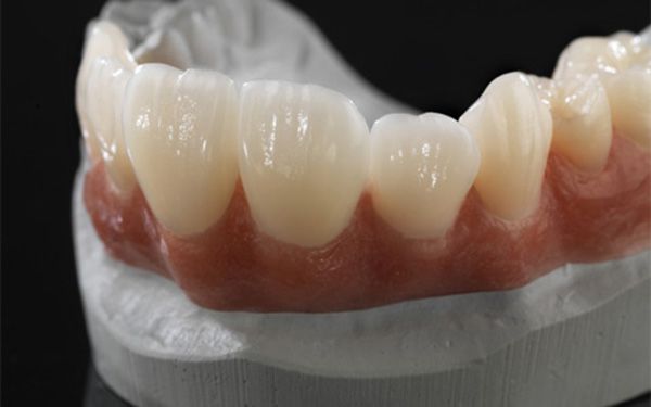 Quy trình bọc răng sứ ceramill Zolid