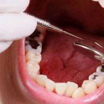 Răng Sứ Zirconia và Cercon nên chọn loại nào tốt nhất?