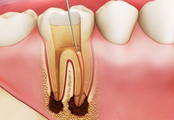 Viêm tủy răng hậu quả bọc răng sứ