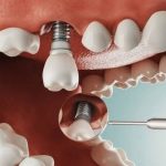 Cấy Ghép Implant Nên Kiêng Ăn Gì ?