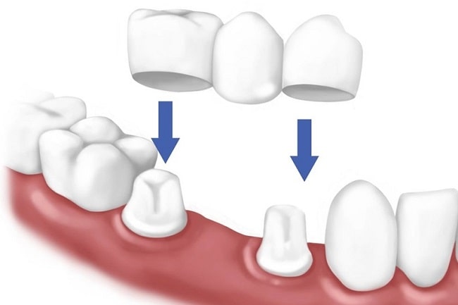 Đối tượng phù hợp với phương pháp bắc cầu răng sứ