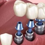 Khi nào cần cấy implant cho răng?