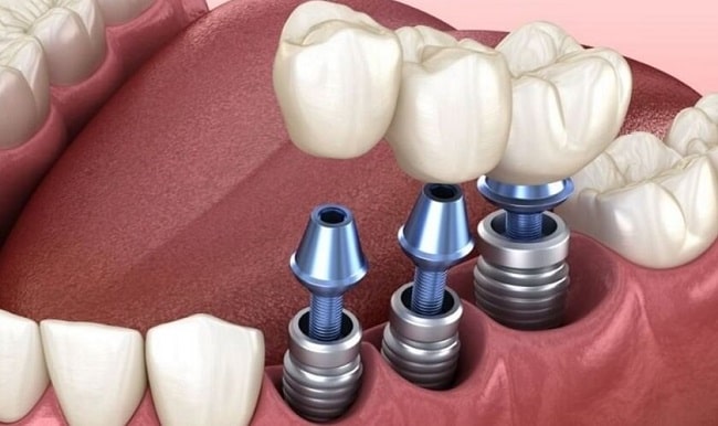 Trụ Implant nào tốt? Những dòng trụ Implant phổ biến nhất hiện nay