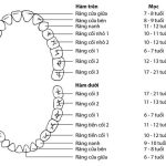 Vì sao dễ bị sâu răng khi niềng răng?