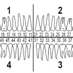 So Sánh Cầu Răng Sứ Và Implant Loại Nào Tốt?