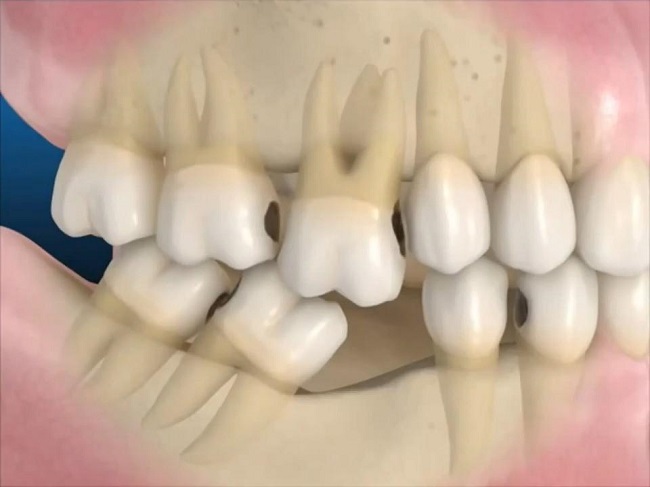 Mất răng số 7 hàm dưới có sao không? Cách điều trị nào tối ưu nhất?