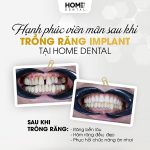 Trồng Răng Hàm Số 7 Giá Bao Nhiêu Tiền?