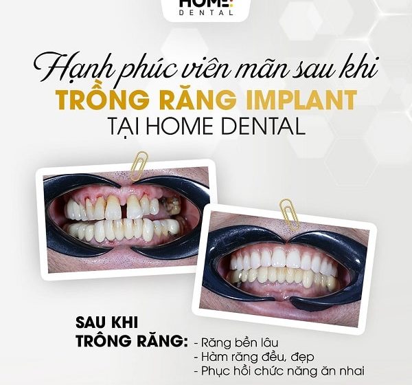 Trồng răng implant toàn hàm là gì?