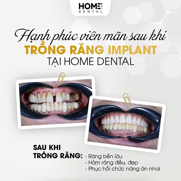 Trồng răng implant toàn hàm là gì?