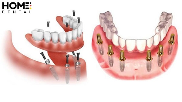 Trồng răng implant All On 6