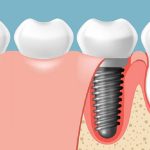 Dịch Vụ Trồng Răng Implant Công Nghệ Đức