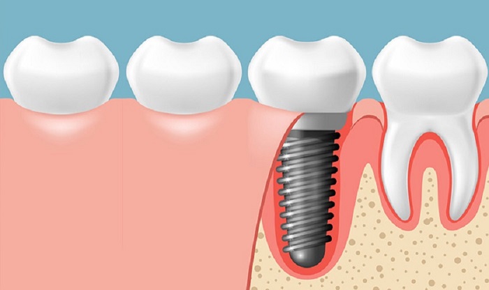 Trồng Răng Implant là gì?