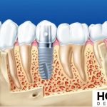 Trồng răng implant toàn hàm là gì?