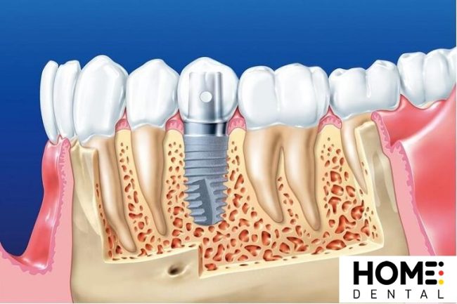 Trồng Răng Hàm Số 7 Giá Bao Nhiêu Tiền?