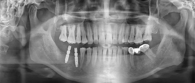 Trồng răng implant có chụp X quang được không?