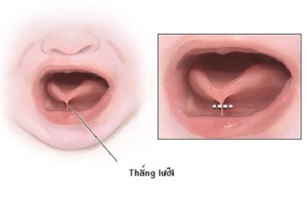 Tại sao nên cắt thắng lưỡi cho trẻ em?