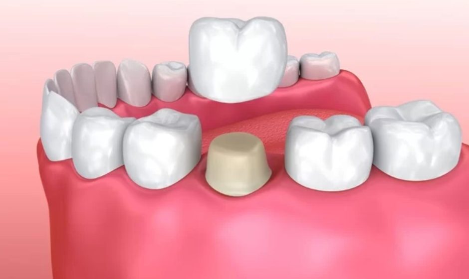 Bọc Răng Sứ Bị Hở Cổ Chân Răng: Nguyên Nhân, Dấu Hiệu và Giải Pháp