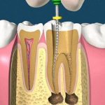 Bọc răng sứ bị đau nhức phải làm sao?