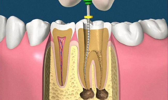 Viêm Tủy Răng Cấp: Nguyên Nhân, Triệu Chứng & Điều Trị Hiệu Quả