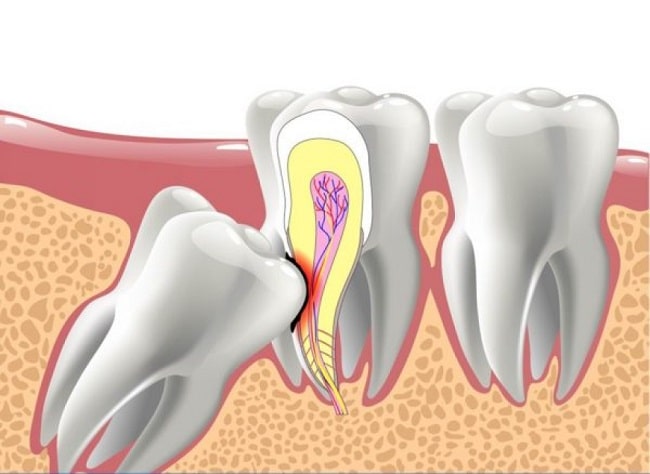 5 Biến Chứng Của Răng Số 8 Mọc Lệch Bạn Cần Biết