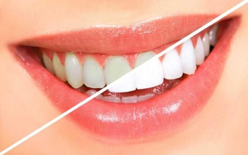 Răng sứ Zirconia có bị ố vàng không?