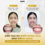 Tại sao nên cắt thắng lưỡi cho trẻ em?