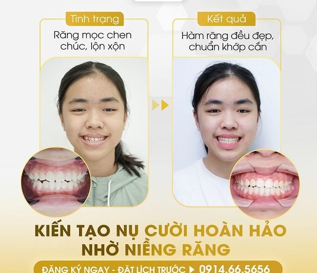 Sai khớp cắn có thể gây hỏng răng không? Tìm hiểu nguyên nhân và cách điều trị