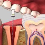 Top 6 địa chỉ bọc răng sứ uy tín tại Hà Nội