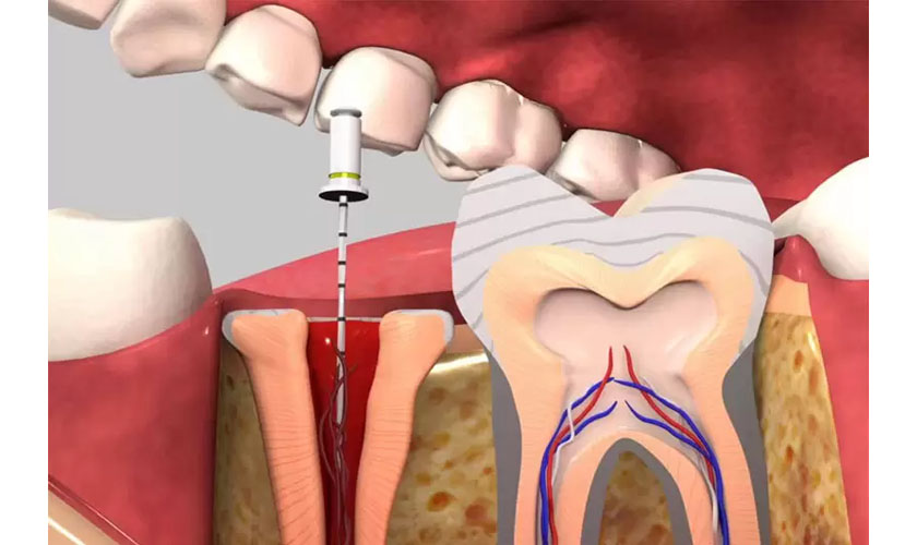 Chi phí lấy tủy bọc răng sứ giá bao nhiêu tiền?