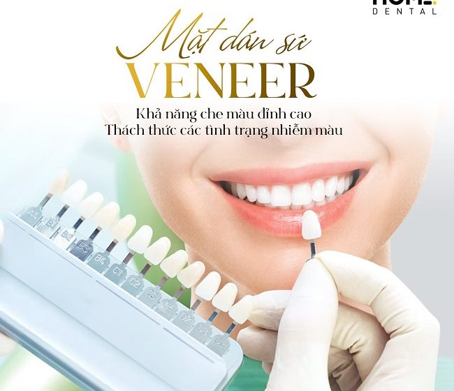 Có nên dán răng sứ veneer không