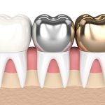 Cách trị hôi miệng khi bọc răng sứ