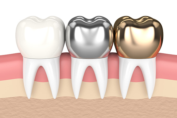 Nên bọc răng sứ kim loại hay Titan?