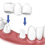 Bọc răng sứ bao lâu thì phải làm lại?