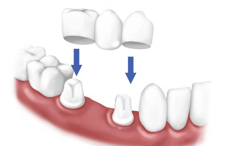 Làm cầu răng sứ có bị hôi miệng không?