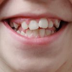 Răng hàm trẻ em có thay không?