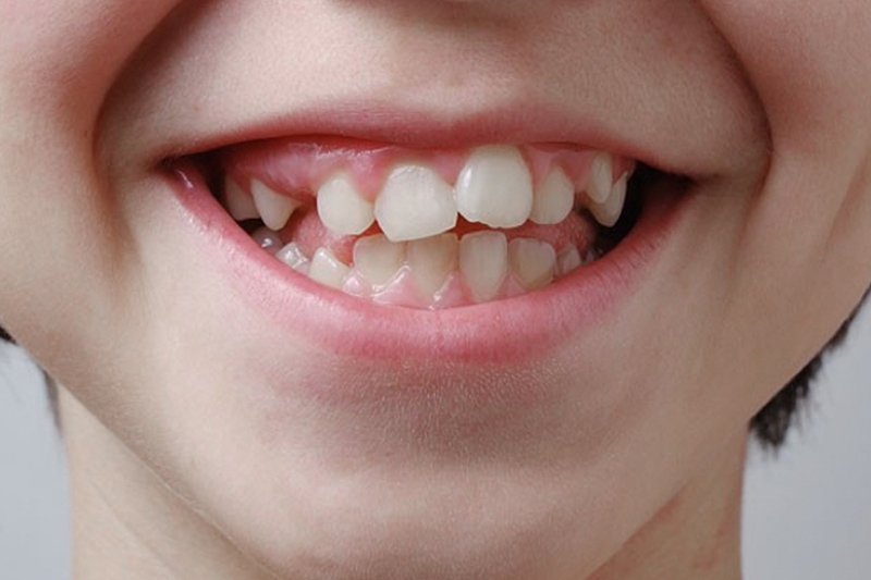 Cách chỉnh răng mọc lệch tại nhà