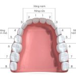 Niềng răng móm trong bao lâu?