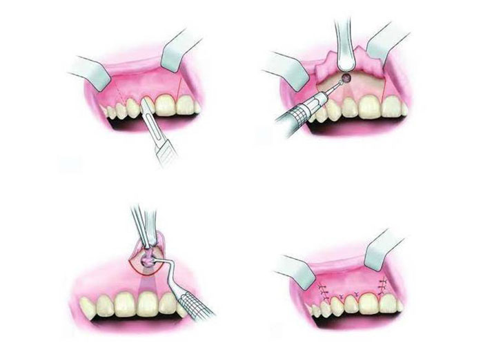 Phẫu thuật cắt chóp răng là gì? Những điều cần biết