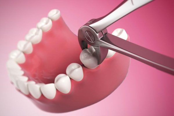 Niềng răng phải nhổ răng nào?