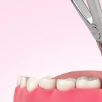 Nhổ răng khôn bị đau tai: Nguyên nhân tiềm ẩn và cách xử lý hiệu quả